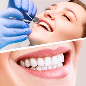 Знижка 30% на професійну чистку зубів від стоматологічної клініки «UV-СИСТЕМ»